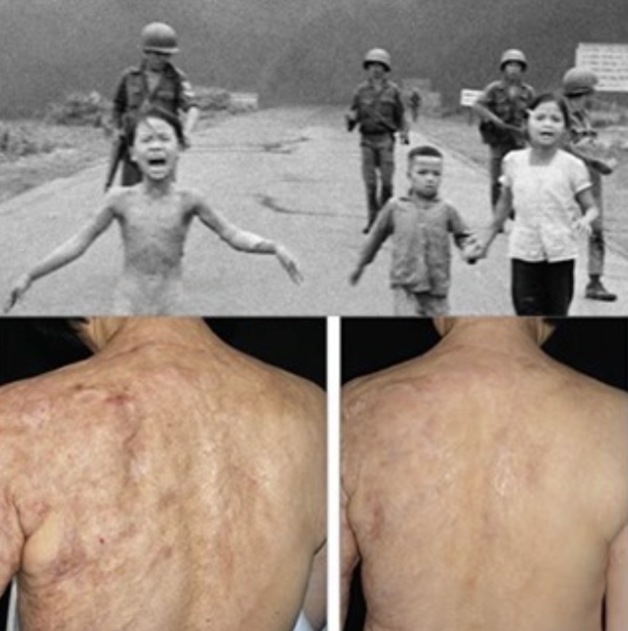 Napalm Girl