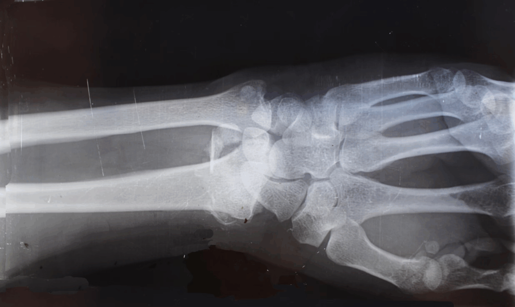 X-ray of wrist bones