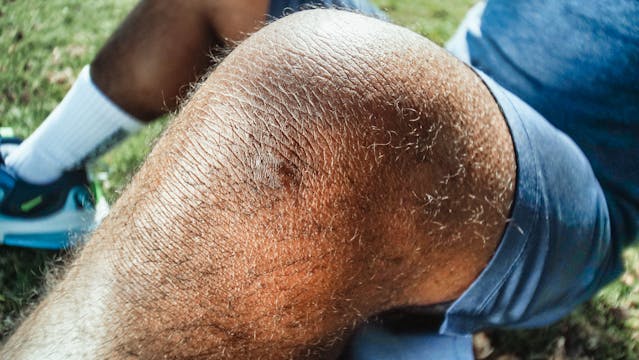 man with bruise on leg