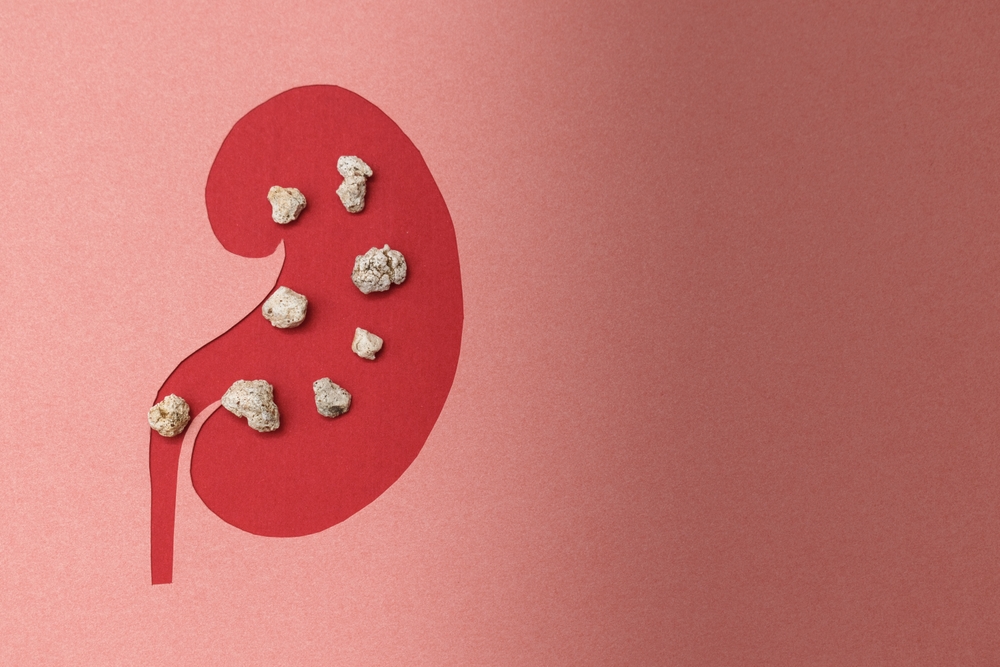 a model of a human kidney made on paper. the concept of timely kidney stones treatment.