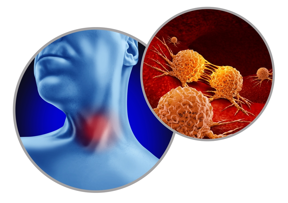Throat Cancer as abnormal cell growth as aryngeal or pharyngeal and HPV related cancers as a patient with a tumor in the neck with 3D illustration elements.
