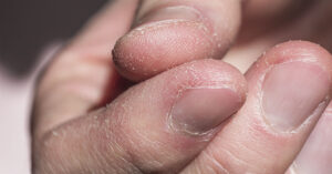 close up of fingers with dry peeling skin, possibly Hand Dermatitis