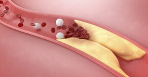 10 of The Best Ways to Help Combat High Cholesterol and High Blood Pressure illustration of plaque build up in an artery