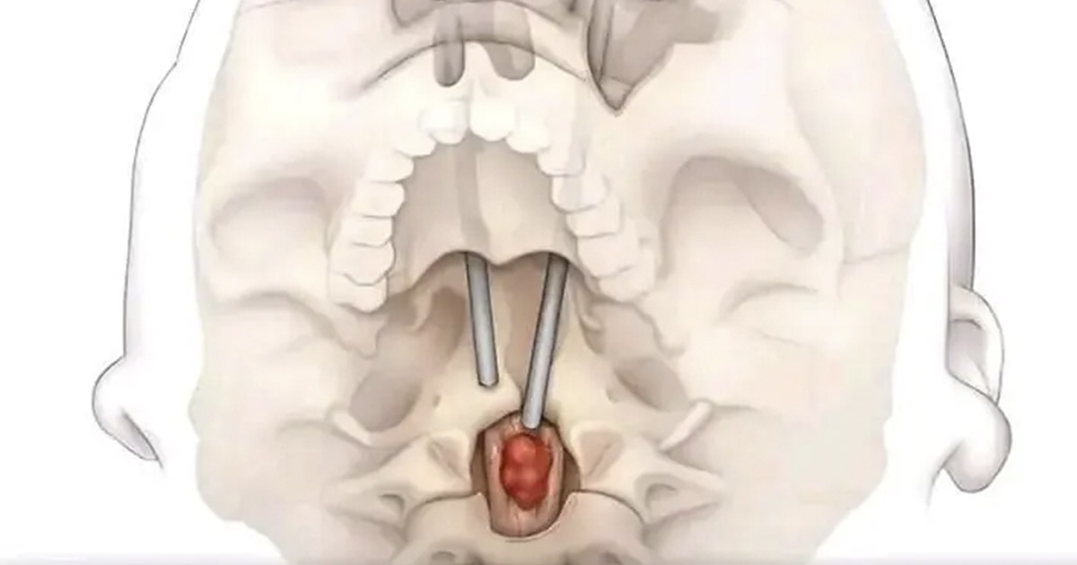 Surgeons Remove Spinal Tumor Through Eye Socket in Medical Breakthrough