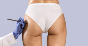 A clinical view from behind of a person wearing white underwear, while a medical professional in a blue glove marks the skin on the upper thigh / buttocks area with a pen.