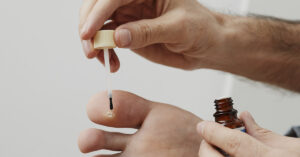 person applying topical medication to wart on their big toe