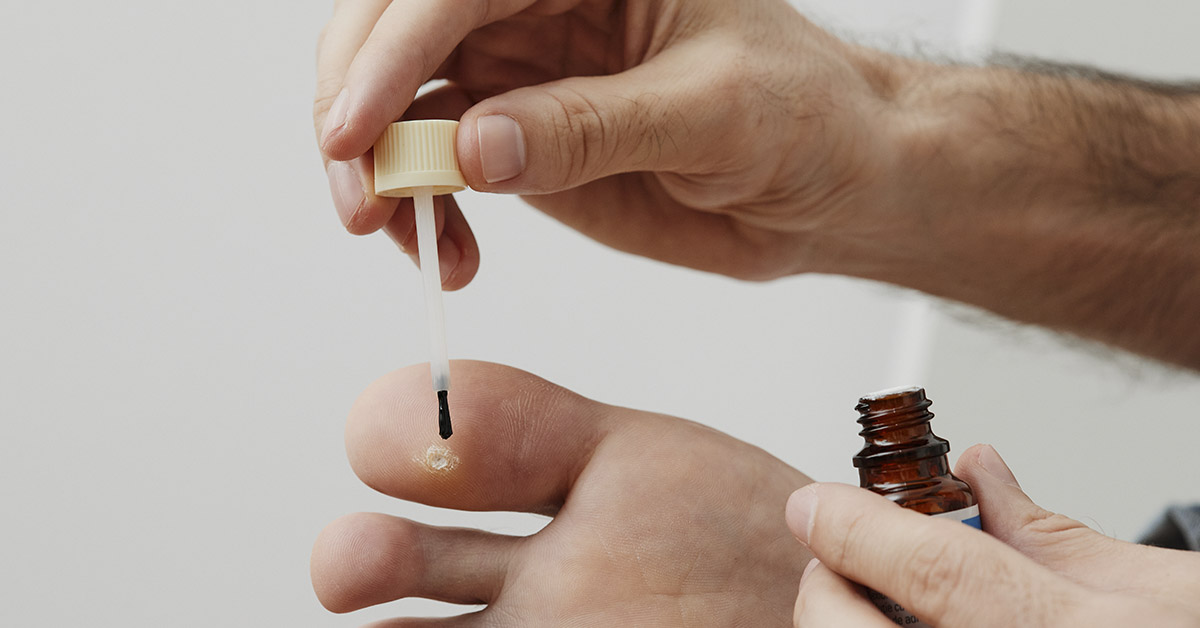 6 Types of Warts (Signs, Symptoms, Home Remedies, and Treatment)