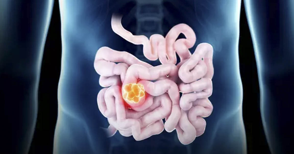 Symptoms ‘Silent’ of Immodine Cancer may be seen as crimes that rise