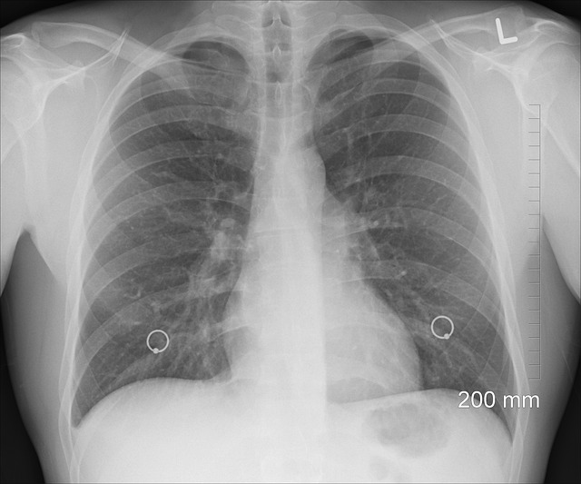 lung x-rays