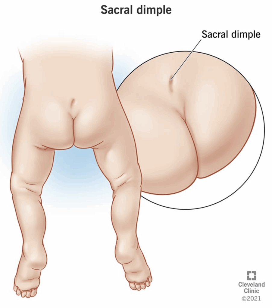 sacral dimple