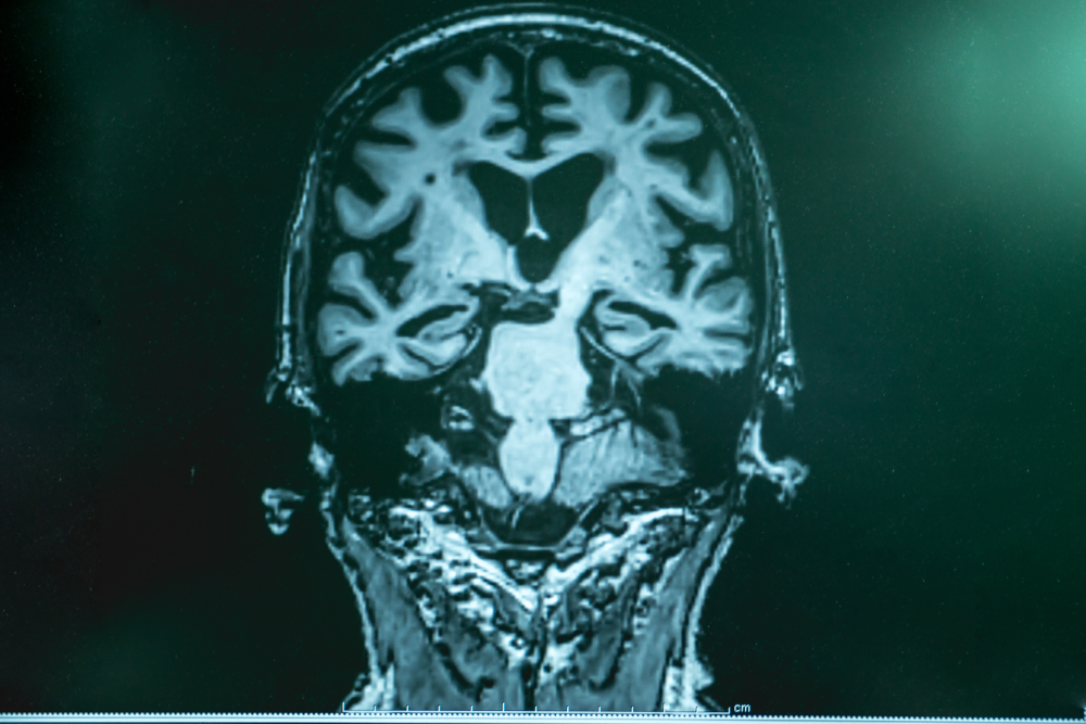 alzheimer's disease with MRI