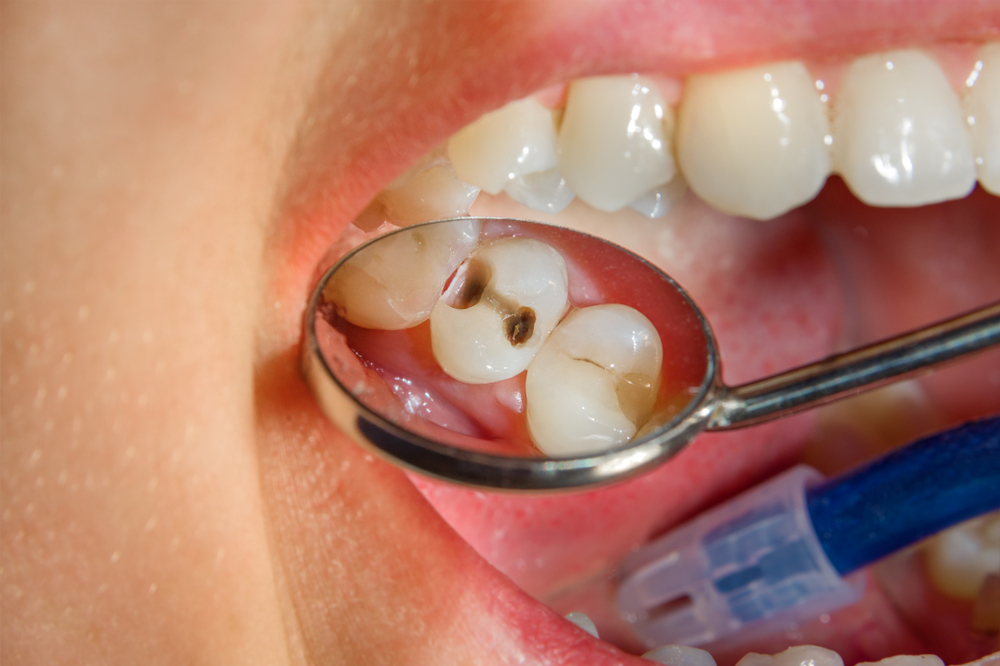 Dental treatment in the dental clinic. Rotten carious tooth close-up macro. Treatment of endodontic canals
