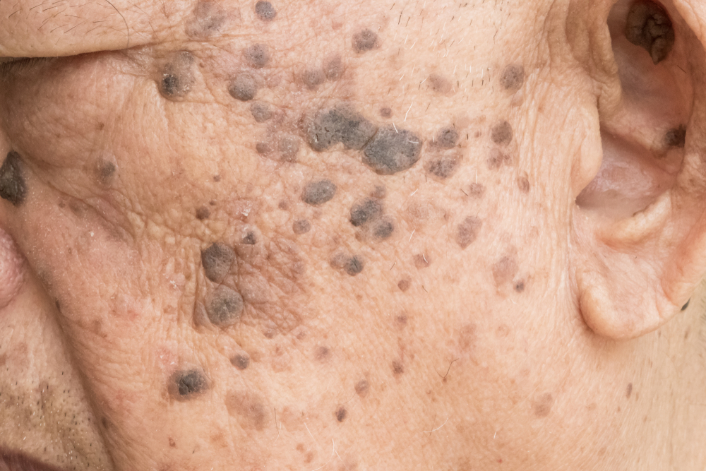 Closeup of age spots skin (liver spots) in 90 years old man.Concept : Skin repair and treatment for elderly and aged people.Selective focus.