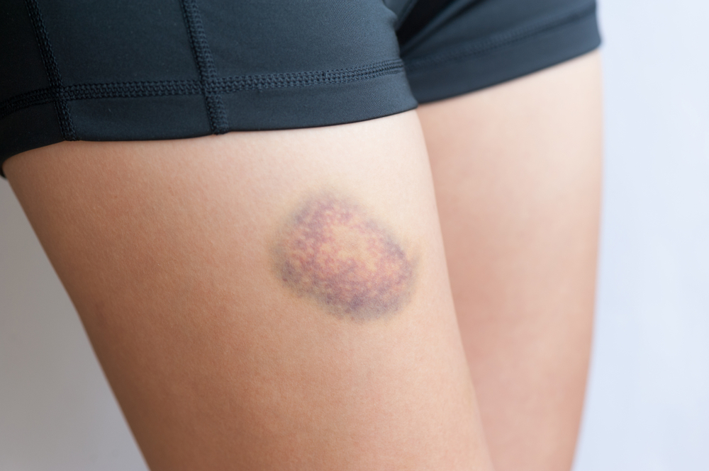people with bruised leg closeup