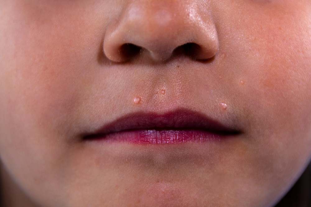 Flat warts in 5 year old girl