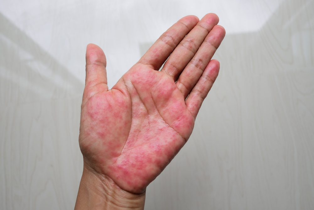 Atopic dermatitis (AD), also known as atopic eczema, is a type of inflammation of the skin (dermatitis) at Hands