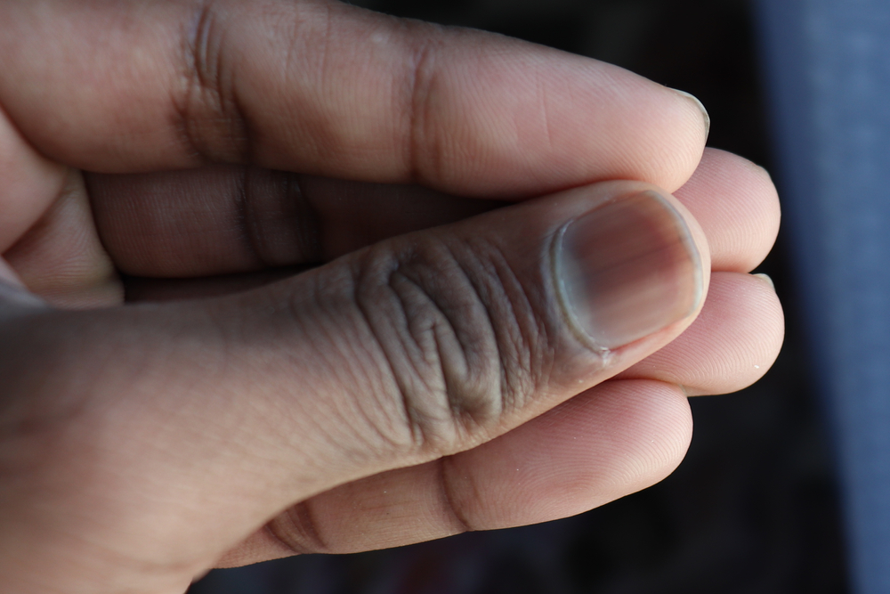 A narrow black line that has formed vertically underneath nail. Splinter hemorrhage.