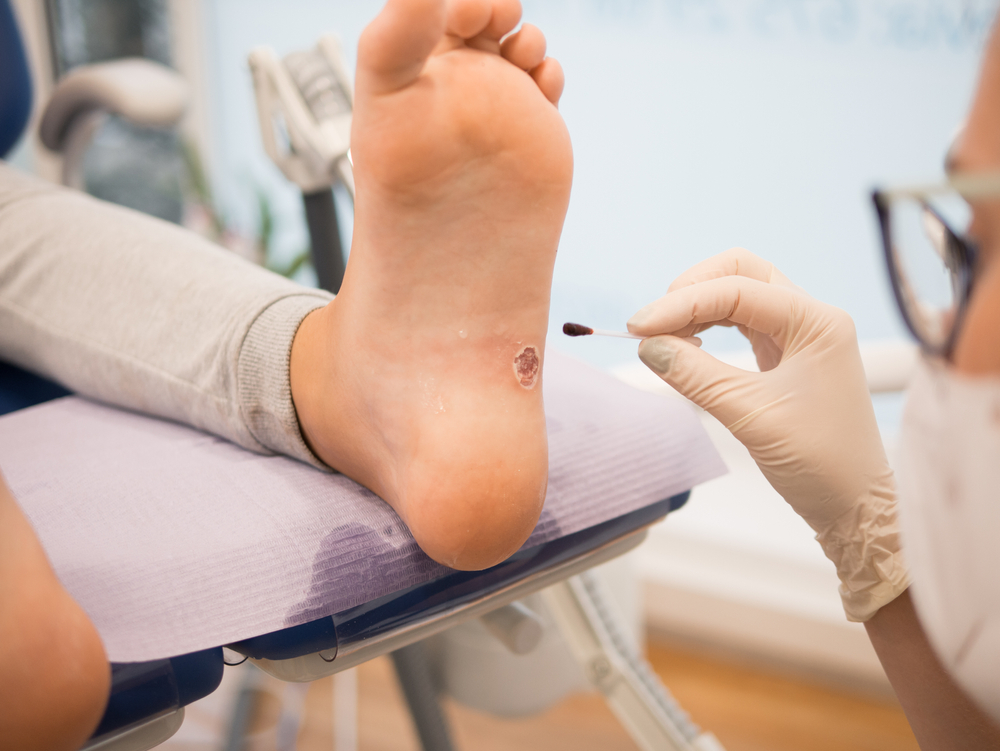 Podiatrist treating a wart verrucas plantar on a patient's foot, no faces shown