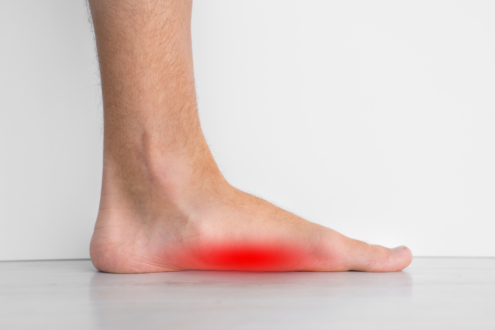 Foot pain because of strong flat feet also called pes planus or fallen arches. The arches on the inside of feet are flattened
