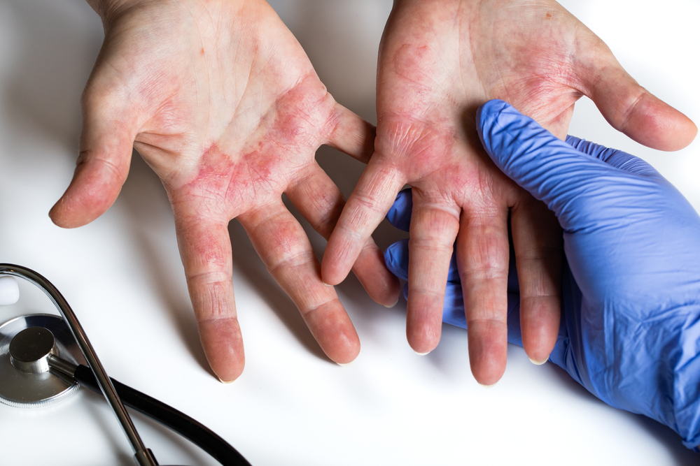 Atopic dermatitis. Red, itchy hands with blisters seen by a dermatologist 