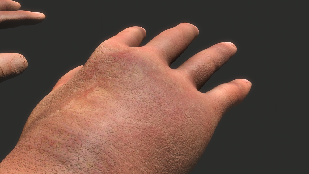 pellagra symptoms in human body.3d illustration