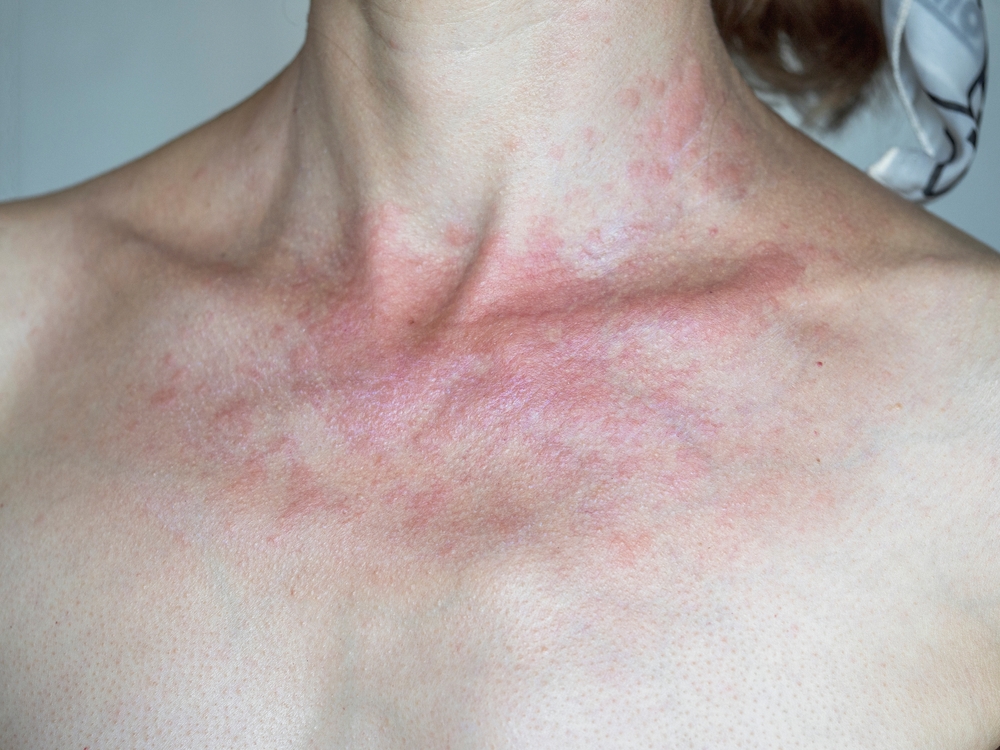 Solar dermatitis. Woman with red sunburned skin against gray background, closeup. 
