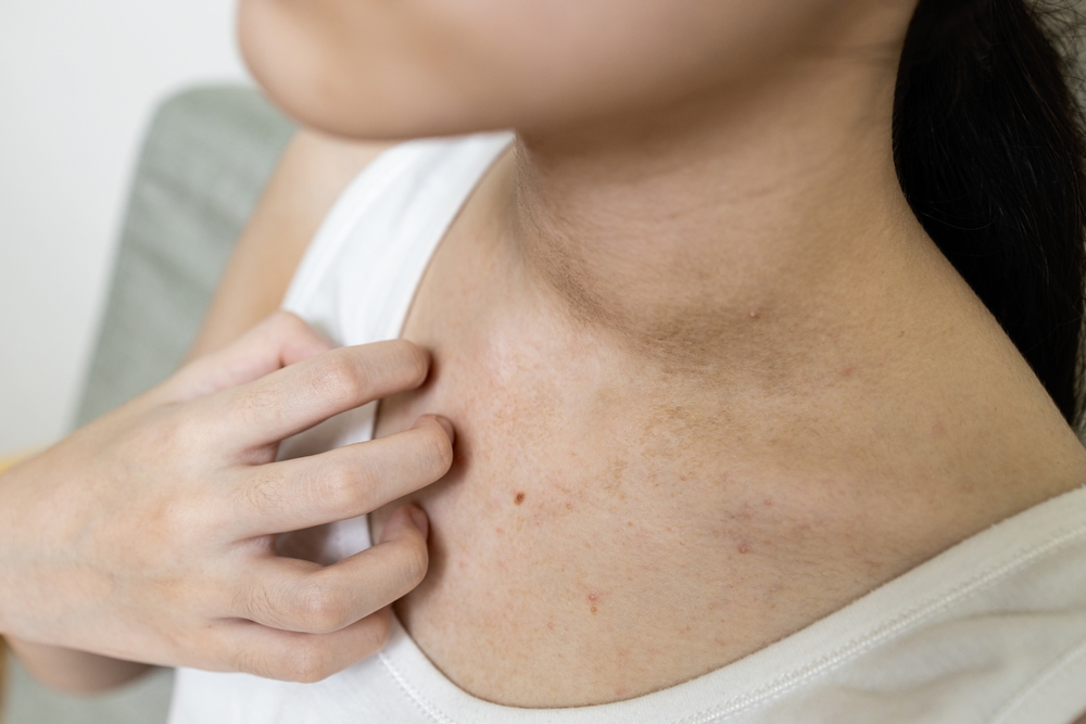Hand of girl scratching skin,red rash from hot weather,sweat allergy,asian woman with itchy skin,itch rash on her chest and neck,sensitive skin,concept of dermatitis,health care,skin disease problems