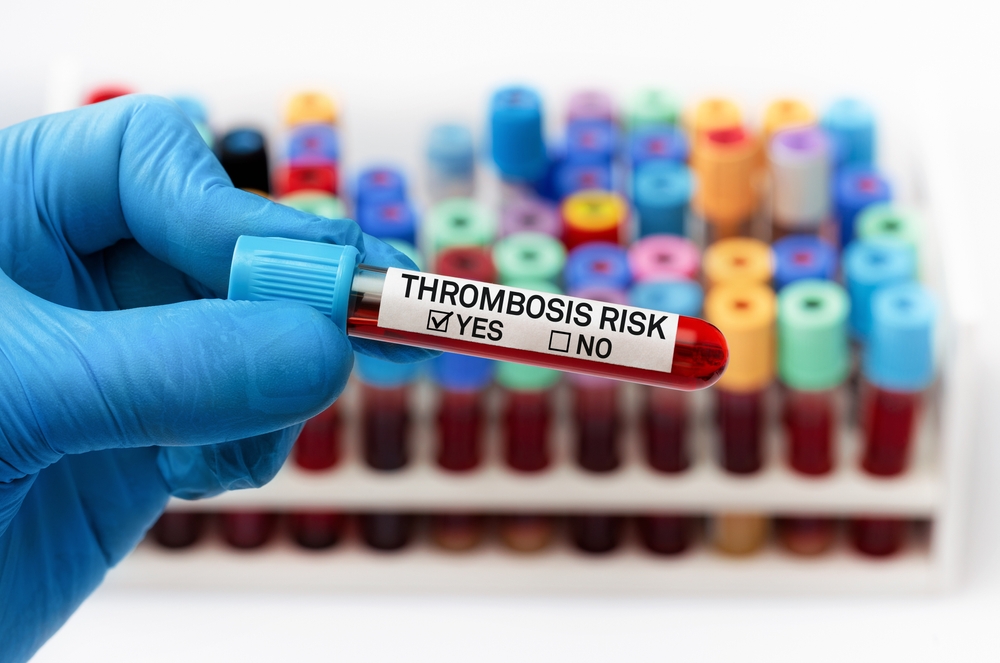 doctor holding Blood tube positive analysis to high risk thrombus. Blood sample test with positive diagnosis of Thrombosis risk in a coagulation test