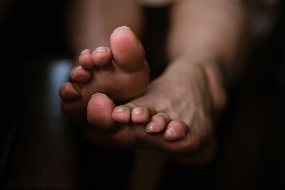 Woman' legs with uneven toe. Close-ups of both feet with selective focus, small toes. Dark joints on the toes. Uneven health of the toes.
