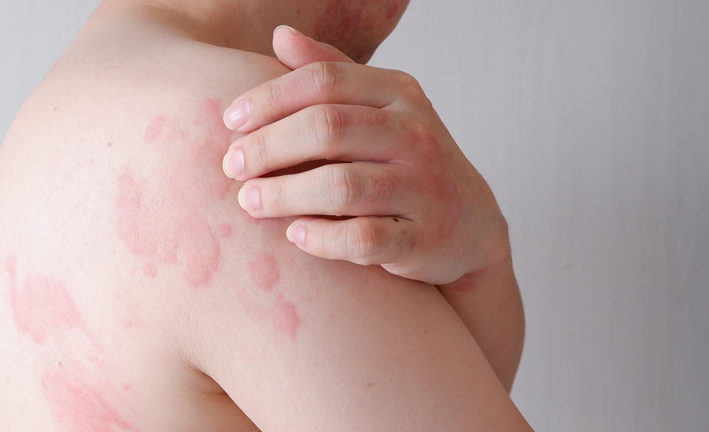 Close up image of skin texture suffering severe urticaria or hives or kaligata. Allergy symptoms.