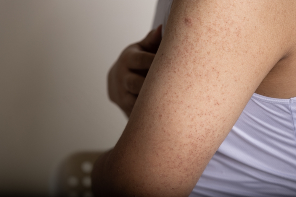 Keratosis Pilaris a harmless skin condition that causes dry, rough patches and tiny bumps, often on the upper arms