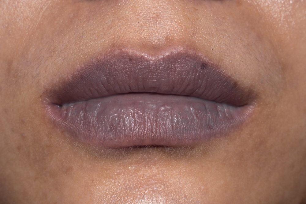 Central cyanosis in Southeast Asian young woman. 