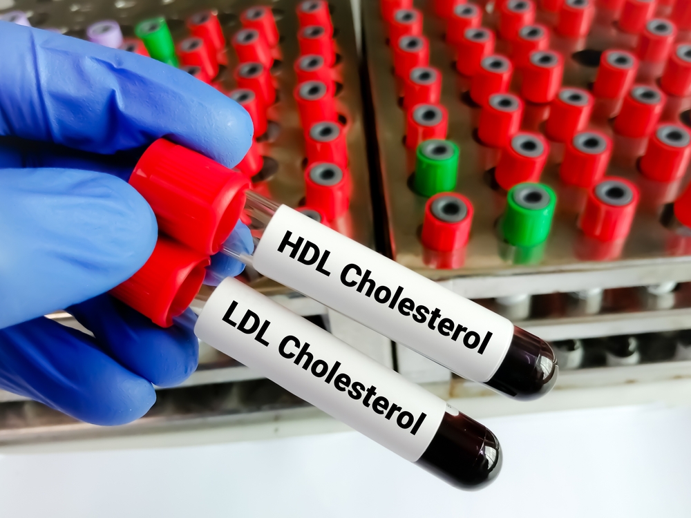 Blood samples for HDL Cholesterol (good cholesterol) and LDL cholesterol test (bad cholesterol), diagnosis of heart diseases.