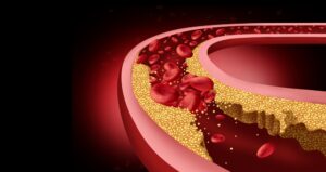10 Subtle Symptoms of Clogged Arteries You Shouldn’t Ignore 3d illustration of clogged arteries