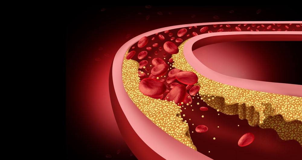 10 Subtle Symptoms of Clogged Arteries You Shouldn’t Ignore