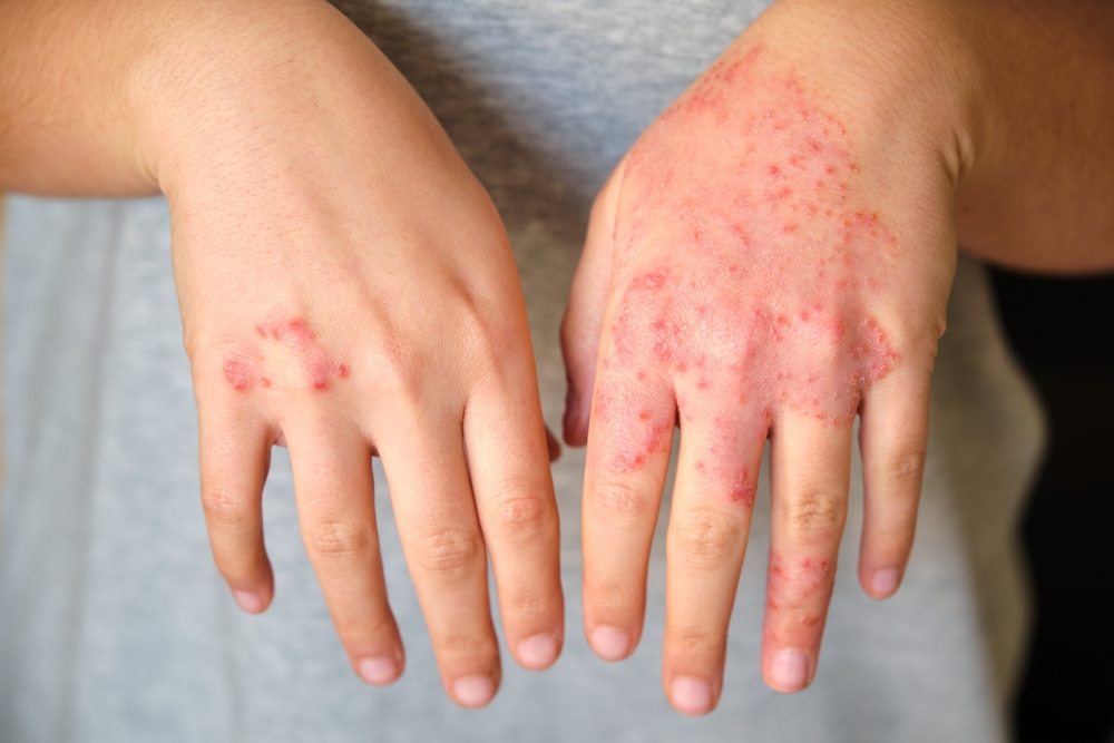 Unrecognizable woman with eczema on hands, atopic dermatitis concept.