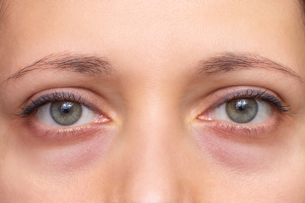 The face of a young woman with a bag under her eye close-up. Swelling of the lower eyelid. Bruises and dark circles appear from insomnia, stress, depression, overwork and fatigue. Unhealthy appearance