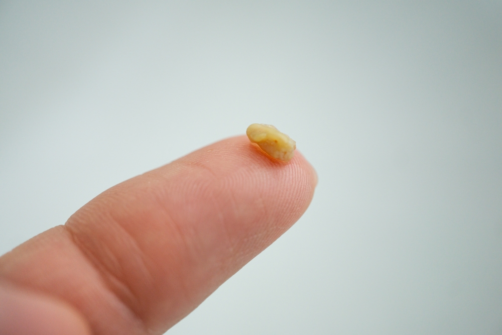 tonsil stone close up on white background - tonsil stones on finger close up
