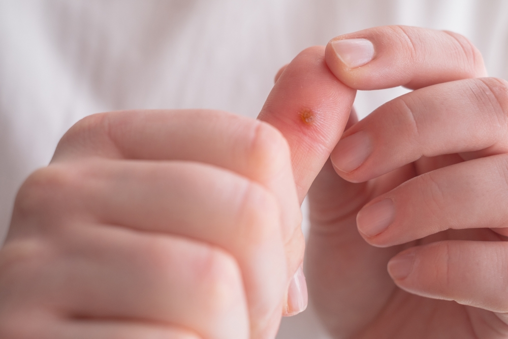 A skin growth on the hand, a wart caused by a viral infection. A woman examines the wart, considering ways to remove it.