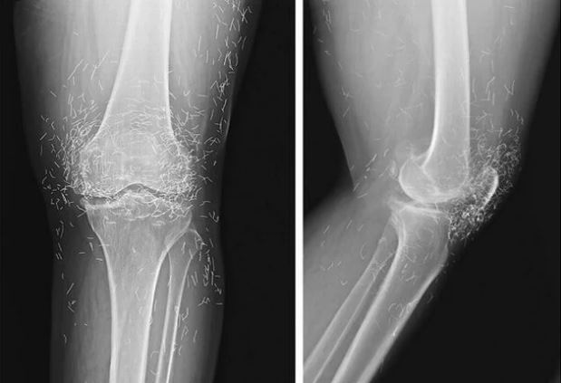 X-ray of acupuncture needles around knees