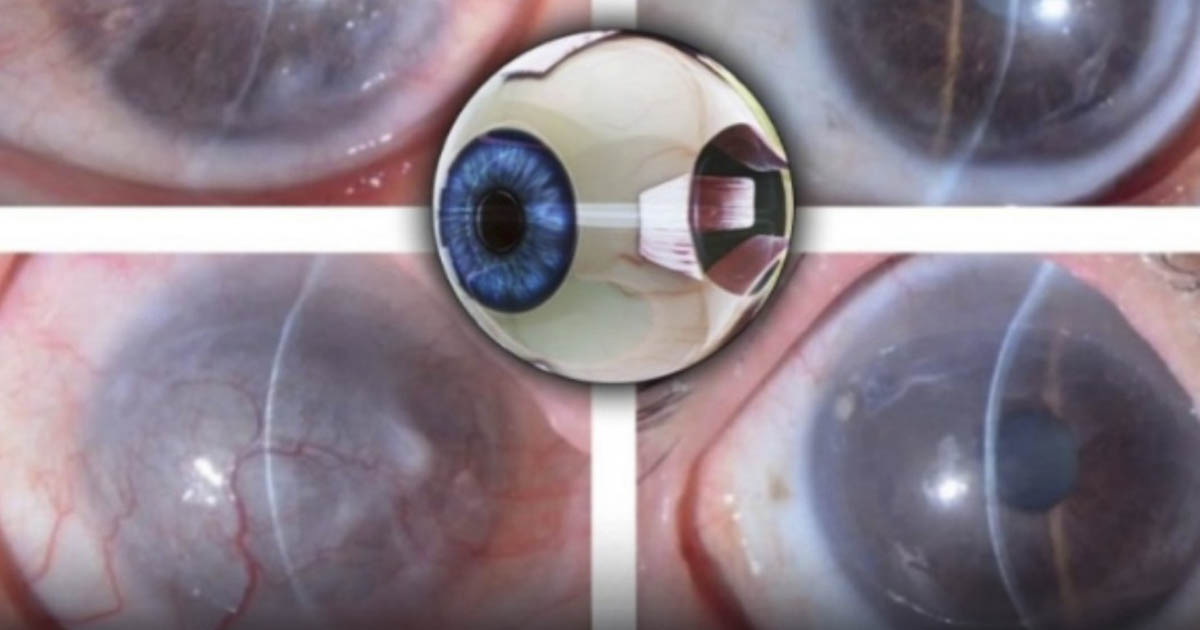 New stem cell therapy shows 92% success in vision restoration New stem cell therapy shows 92% success in vision restoration