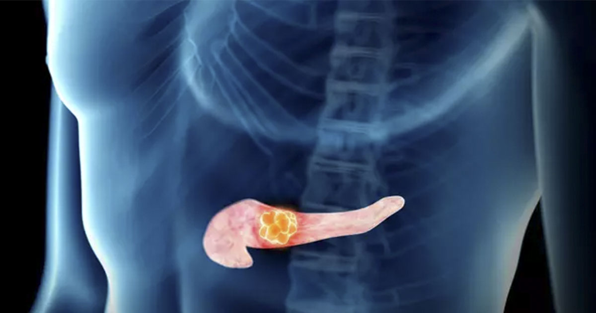 Oral health may be tied to some of the deadliest cancers Oral health may be tied to some of the deadliest cancers