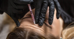 Cosmetic Doctor Conducts Self-Experiment with Botox - One Side of Her Face Tells All woman with receiving a Botox injection in her forehead