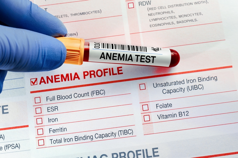 The blood sample of anemia profile test test is on the lab. The doctor holds a test for a blood tube in the application form for anemia testing