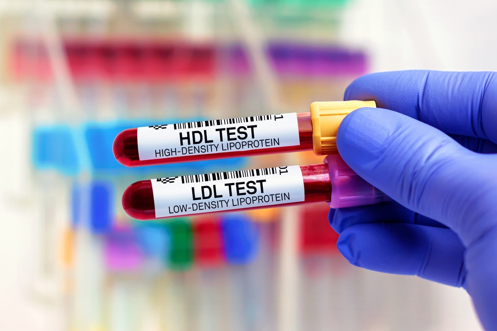 Patient blood samples for low density lipoprotein HDL and low density lipoprotein ldl lab test. Blood tubes for HDL High Density Lipoprotein and LDL low density lipoprotein test