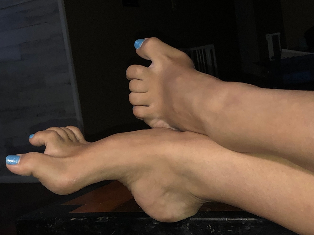 Phoenix Arizona USA August 1st 2019 woman’s feet with Charcot Marie Tooth Disease 