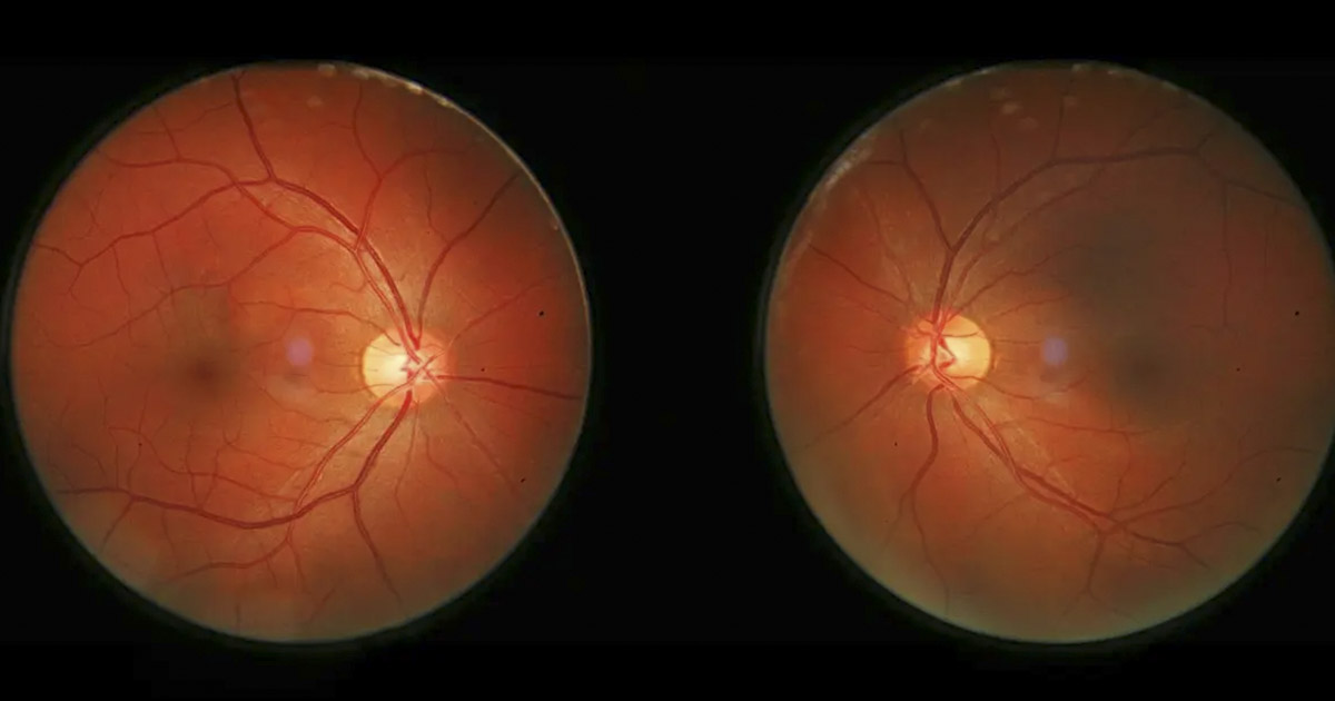 Retinal degeneration can be treated with drugs designed for Alloodlism