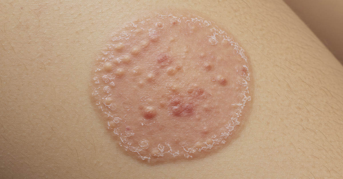 Ringworm 101: Causes, Symptoms, and Simple Remedies You Can Try at Home