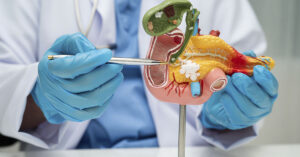 Pancreatic Cancer: 4 Leg Symptoms You Might Be Overlooking Doctor wearing blue medical gloves, pointing model of pancreas.