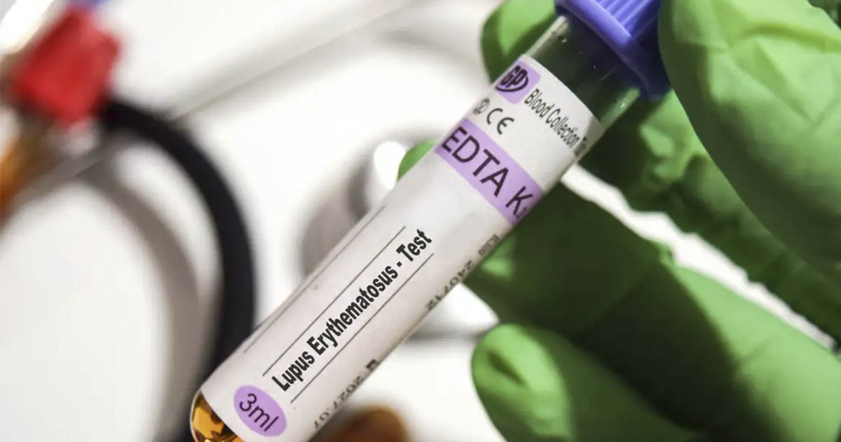 Researchers Find Strongest Link Yet Between Epstein-Barr Virus and Lupus